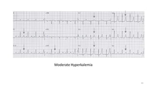 Moderate Hyperkalemia
83
 
