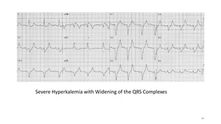 Severe Hyperkalemia with Widening of the QRS Complexes
84
 