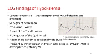 ECG Findings of Hypokalemia
• Dynamic changes in T-wave morphology (T-wave flattening and
inversion)
• ST-segment depression
• Prominent U waves
• Fusion of the T and U waves
• Prolongation of the QU interval
• P pulmonale pattern is occasionally observed
• Frequent supraventricular and ventricular ectopics, SVT, potential to
develop life-threatening VT.
T wave inversion and prominent U waves
in hypokalaemia
85
 