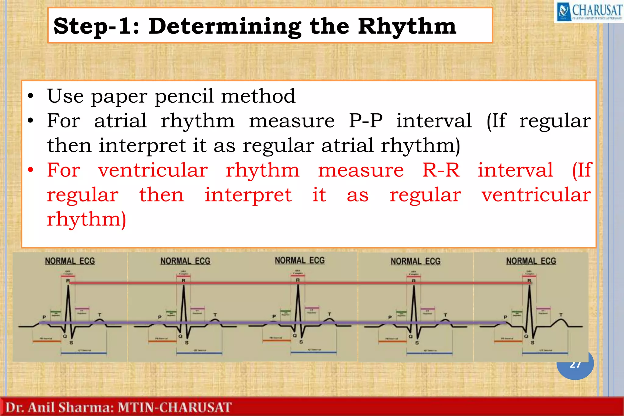 27
Step-1: Determining the Rhythm
• Use paper pencil method
• For atrial rhythm measure P-P interval (If regular
then interpret it as regular atrial rhythm)
• For ventricular rhythm measure R-R interval (If
regular then interpret it as regular ventricular
rhythm)
 