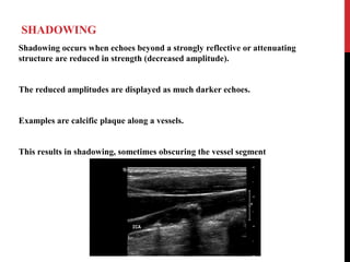 SHADOWING
Shadowing occurs when echoes beyond a strongly reflective or attenuating
structure are reduced in strength (decreased amplitude).
The reduced amplitudes are displayed as much darker echoes.
Examples are calcific plaque along a vessels.
This results in shadowing, sometimes obscuring the vessel segment
 
