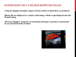 GENERATION OF A COLOUR DOPPLER IMAGE
Using the Doppler principle, images of tissue motion or blood flow are produced
Blood cells are displayed as a colour coded image, which is superimposed onto the
B-mode image
The mean Doppler frequency in each blood cell along a scan line is represented
by an associated shade of colour
 