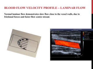 BLOOD FLOW VELOCITY PROFILE – LAMINAR FLOW
Normal laminar flow demonstrates slow flow close to the vessel walls, due to
frictional forces and faster flow centre stream
 