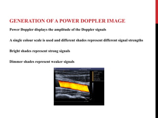 GENERATION OF A POWER DOPPLER IMAGE
Power Doppler displays the amplitude of the Doppler signals
A single colour scale is used and different shades represent different signal strengths
Bright shades represent strong signals
Dimmer shades represent weaker signals
 