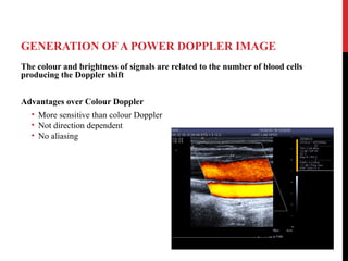 GENERATION OF A POWER DOPPLER IMAGE
The colour and brightness of signals are related to the number of blood cells
producing the Doppler shift
Advantages over Colour Doppler
• More sensitive than colour Doppler
• Not direction dependent
• No aliasing
 