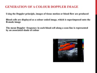 GENERATION OF A COLOUR DOPPLER IMAGE
Using the Doppler principle, images of tissue motion or blood flow are produced
Blood...