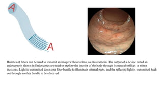 Bundles of fibers can be used to transmit an image without a lens, as illustrated in. The output of a device called an
endoscope is shown in Endoscopes are used to explore the interior of the body through its natural orifices or minor
incisions. Light is transmitted down one fiber bundle to illuminate internal parts, and the reflected light is transmitted back
out through another bundle to be observed.
 