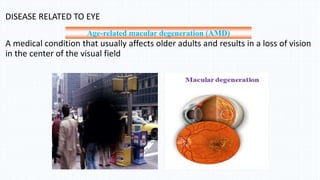 DISEASE RELATED TO EYE
A medical condition that usually affects older adults and results in a loss of vision
in the center of the visual field
Age-related macular degeneration (AMD)
 