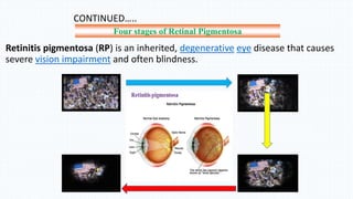 CONTINUED…..
Retinitis pigmentosa (RP) is an inherited, degenerative eye disease that causes
severe vision impairment and often blindness.
Four stages of Retinal Pigmentosa
 
