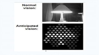 Working
Camera on glasses views image
Signals are sent to video processing
microchip
Processed information is sent back
to receiver
Receiver sends information to
electrodes in retinal implant
Electrodes stimulate retina to send
information to brain
 