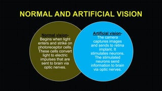 Normal vision-
Begins when light
enters and strike on
photoreceptor cells.
These cells convert
light to electric
impulses that are
sent to brain via
optic nerves.
Artificial vision-
The camera
captures images
and sends to retina
implant. It
stimulates neurons.
The stimulated
neurons send
information to brain
via optic nerves.
 