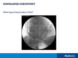 What type of pacemaker is this?
KNOWLEDGE CHECKPOINT
 