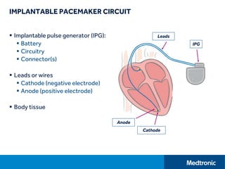 IMPLANTABLE PACEMAKER CIRCUIT
 Implantable pulse generator (IPG):
 Battery
 Circuitry
 Connector(s)
 Leads or wires
 Cathode (negative electrode)
 Anode (positive electrode)
 Body tissue
IPG
Leads
Anode
Cathode
 
