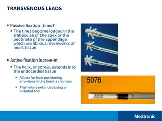 TRANSVENOUS LEADS
 Passive fixation (tined)
 The tines become lodged in the
trabeculae of the apex or the
pectinate of the appendage
which are fibrous meshworks of
heart tissue
 Active fixation (screw-in)
 The helix, or screw, extends into
the endocardial tissue
 Allows for lead positioning
anywhere in the heart’s chamber
 The helix is extended using an
included tool
 