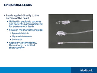 EPICARDIAL LEADS
 Leads applied directly to the
surface of the heart
 Utilized in pediatric patients
and patients contraindicated
for transvenous leads
 Fixation mechanisms include:
 Epicardial stab-in
 Myocardial screw-in
 Suture-on
 Applied via sternotomy,
thoroscopy, or limited
thoracotomy
 