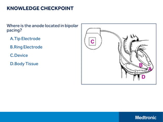 KNOWLEDGE CHECKPOINT
Where is the anode located in bipolar
pacing?
A.Tip Electrode
B.Ring Electrode
C.Device
D.Body Tissue
 