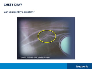 CHEST X RAY
Can you identify a problem?
1st Rib-Clavicle Crush (lead fracture)
 