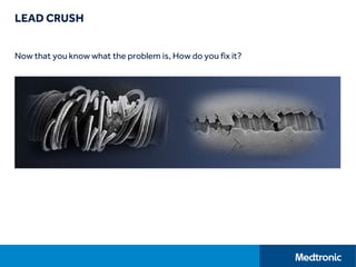 LEAD CRUSH
Now that you know what the problem is, How do you fix it?
 