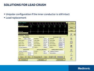 SOLUTIONS FOR LEAD CRUSH
 Unipolar configuration if the inner conductor is still intact
 Lead replacement
 