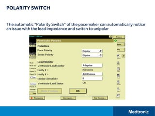 POLARITY SWITCH
The automatic “Polarity Switch” of the pacemaker can automatically notice
an issue with the lead impedance and switch to unipolar
 