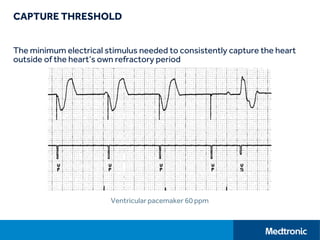 CAPTURE THRESHOLD
The minimum electrical stimulus needed to consistently capture the heart
outside of the heart’s own refractory period
Ventricular pacemaker 60 ppm
 