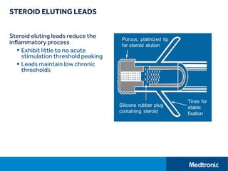 STEROID ELUTING LEADS
Steroid eluting leads reduce the
inflammatory process
 Exhibit little to no acute
stimulation threshold peaking
 Leads maintain low chronic
thresholds
 