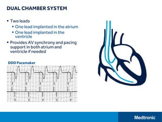 DUAL CHAMBER SYSTEM
 Two leads
 One lead implanted in the atrium
 One lead implanted in the
ventricle
 Provides AV synchrony and pacing
support in both atrium and
ventricle if needed
DDD Pacemaker
 