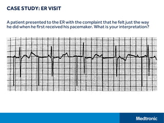 CASE STUDY: ER VISIT
A patient presented to the ER with the complaint that he felt just the way
he did when he first received his pacemaker. What is your interpretation?
 