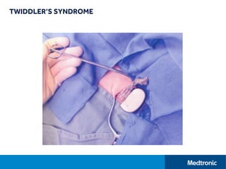 TWIDDLER’S SYNDROME
 