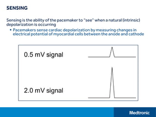 SENSING
Sensing is the ability of the pacemaker to “see” when a natural (intrinsic)
depolarization is occurring
 Pacemakers sense cardiac depolarization by measuring changes in
electrical potential of myocardial cells between the anode and cathode
 