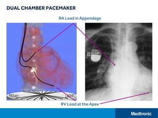 DUAL CHAMBER PACEMAKER
RA Lead in Appendage
RV Lead at the Apex
 