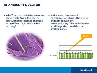 CHANGING THE VECTOR
 A PVC occurs, which is conducted
abnormally. Since the vector
relative to the lead has changed,
what effect might this have on
sensing?
 In this case, the wave of
depolarization strikes the anode
and cathode almost
simultaneously. This will create a
smaller gradient and thus, a
smaller signal.
 