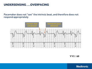 UNDERSENSING . . .OVERPACING
Pacemaker does not “see” the intrinsic beat, and therefore does not
respond appropriately
 