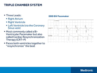 TRIPLE CHAMBER SYSTEM
 Three Leads:
 Right Atrium
 Right Ventricle
 Left Ventricle (via the Coronary
Sinus vein)
 Most commonly called a Bi-
Ventricular Pacemaker but also
called Cardiac Resynchronization
Therapy (CRT–P)
 Paces both ventricles together to
“resynchronize” the beat
DDD BiV Pacemaker
 