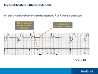 OVERSENSING …UNDERPACING
An electrical signal other than the intended P or R wave is detected
 