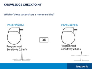 KNOWLEDGE CHECKPOINT
Which of these pacemakers is more sensitive?
PACEMAKER A PACEMAKER B
 