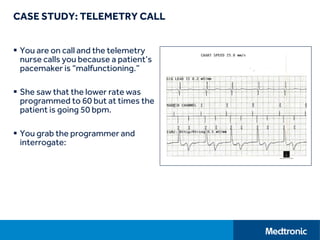 CASE STUDY: TELEMETRY CALL
 You are on call and the telemetry
nurse calls you because a patient’s
pacemaker is “malfunctioning.”
 She saw that the lower rate was
programmed to 60 but at times the
patient is going 50 bpm.
 You grab the programmer and
interrogate:
 