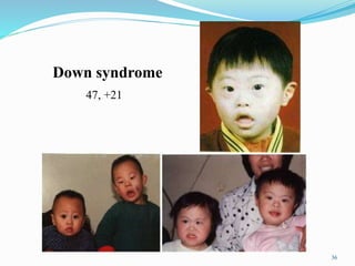 36
Down syndrome
47, +21
 