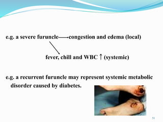 e.g. a severe furuncle congestion and edema (local)
fever, chill and WBC ￪ (systemic)
e.g. a recurrent furuncle may represent systemic metabolic
disorder caused by diabetes.
51
 