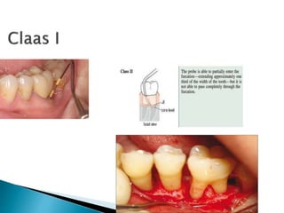 Basic periodontal examination