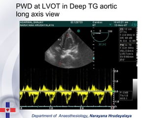 PWD at LVOT in Deep TG aortic long axis view 