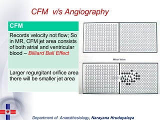 CFM  v/s Angiography CFM Angiography Records velocity not flow; So in MR, CFM jet area consists of both atrial and ventric...