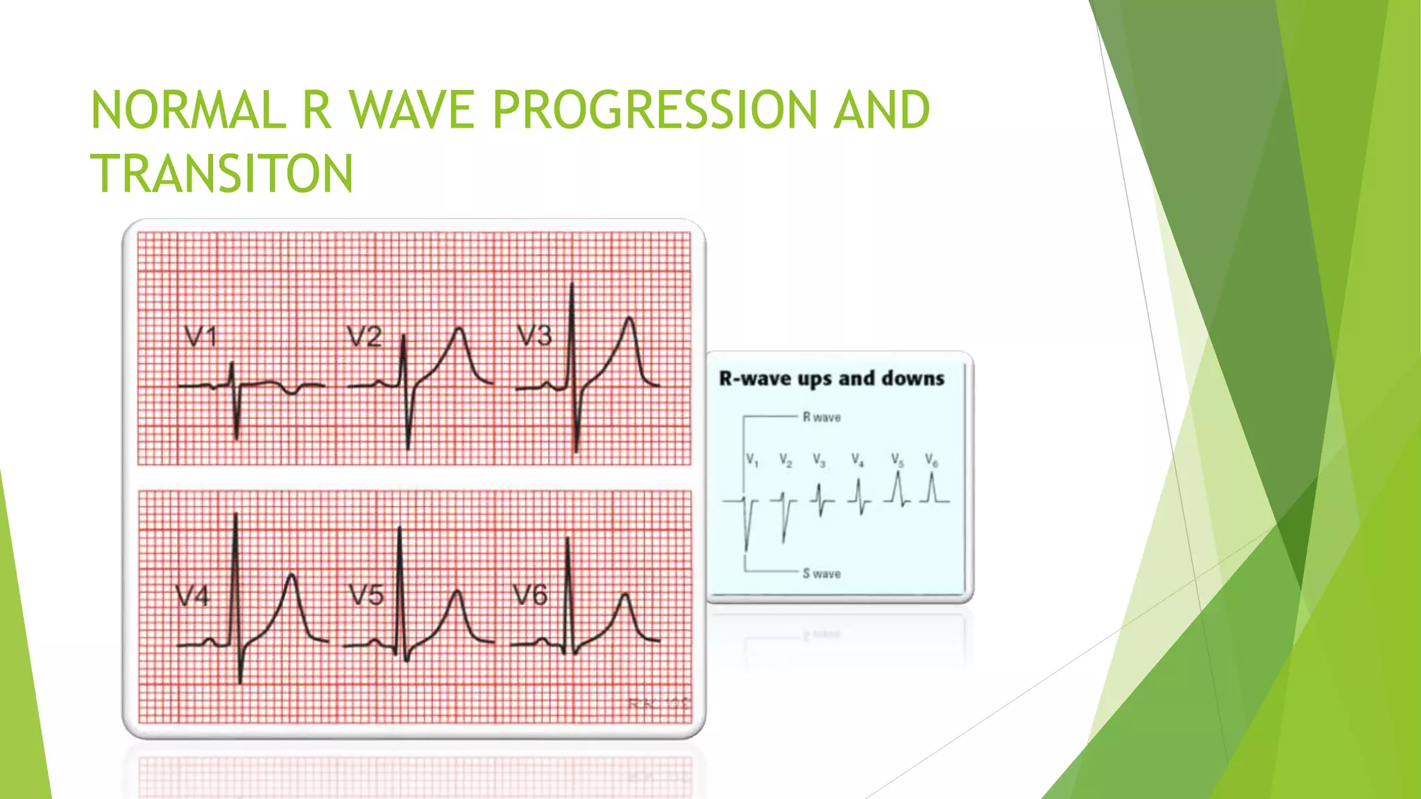 NORMAL R WAVE PROGRESSION AND
TRANSITON
 