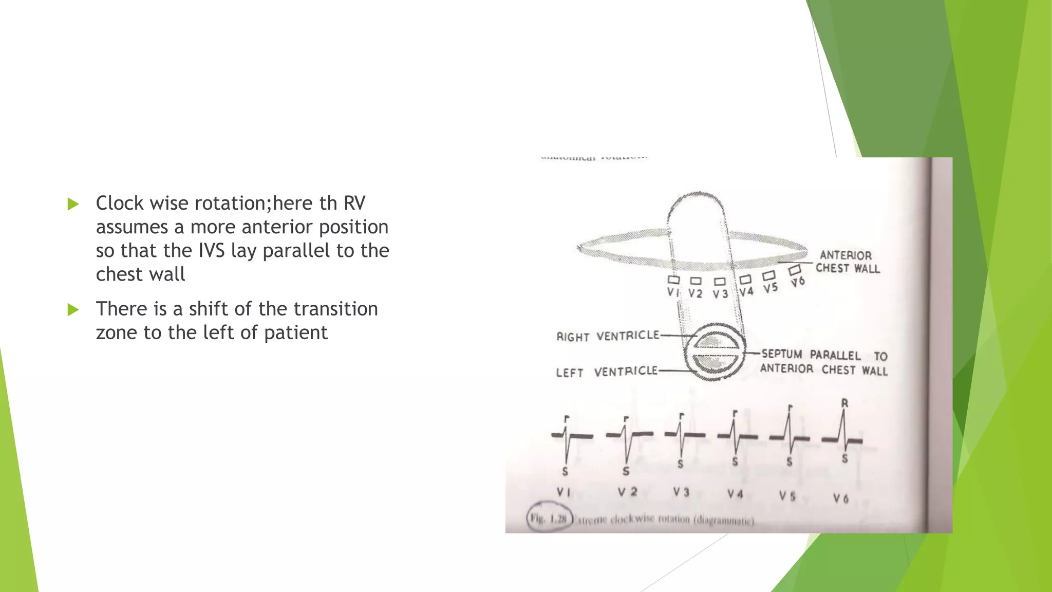  Clock wise rotation;here th RV
assumes a more anterior position
so that the IVS lay parallel to the
chest wall
 There is a shift of the transition
zone to the left of patient
 
