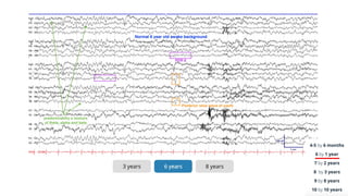 Basic Principle of Pediatric EEG + Normal EEG in Awake and Sleep ...