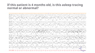 Basic Principle of Pediatric EEG + Normal EEG in Awake and Sleep ...