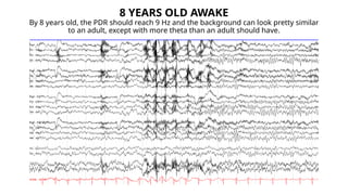 Basic Principle of Pediatric EEG + Normal EEG in Awake and Sleep ...