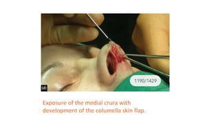 Basic principle of rhinoplasty. by venukumar.t | PPTX
