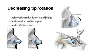 Basic principle of rhinoplasty. by venukumar.t | PPTX