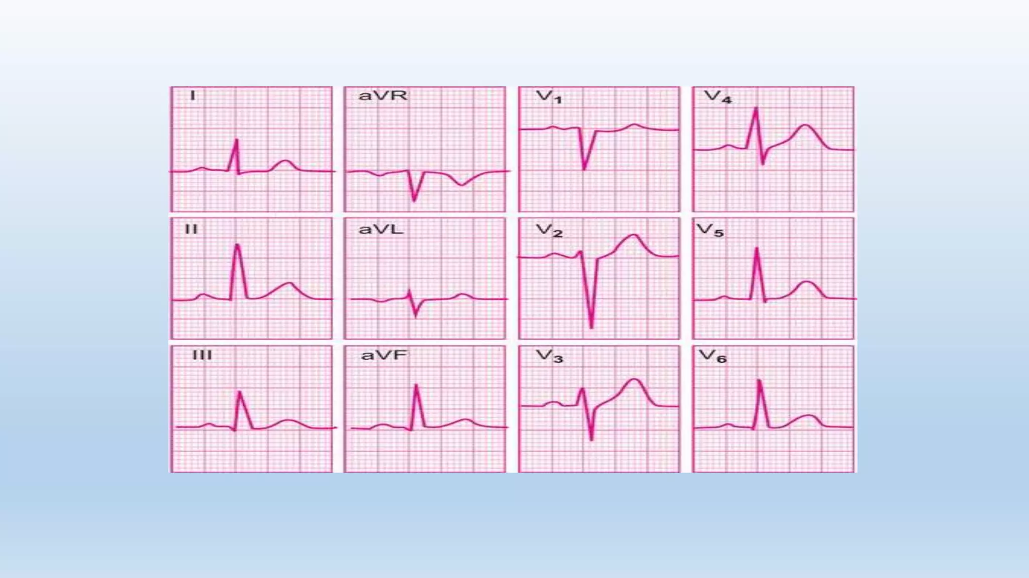 BASICS OF ECG pptx.pptx | Heart and Cardiovascular Diseases | Diseases ...